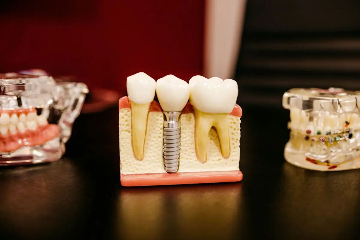 Modelo de implante dental de estudio